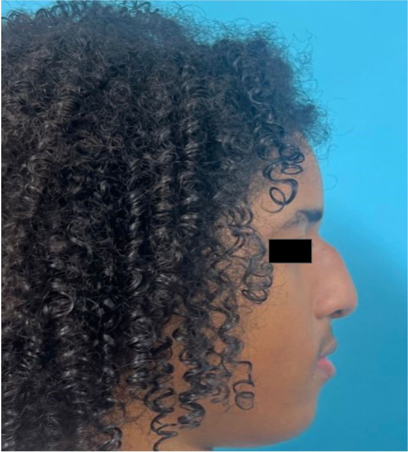 Before rhinoseptoplasty showing the nose prior to surgery, right side view
