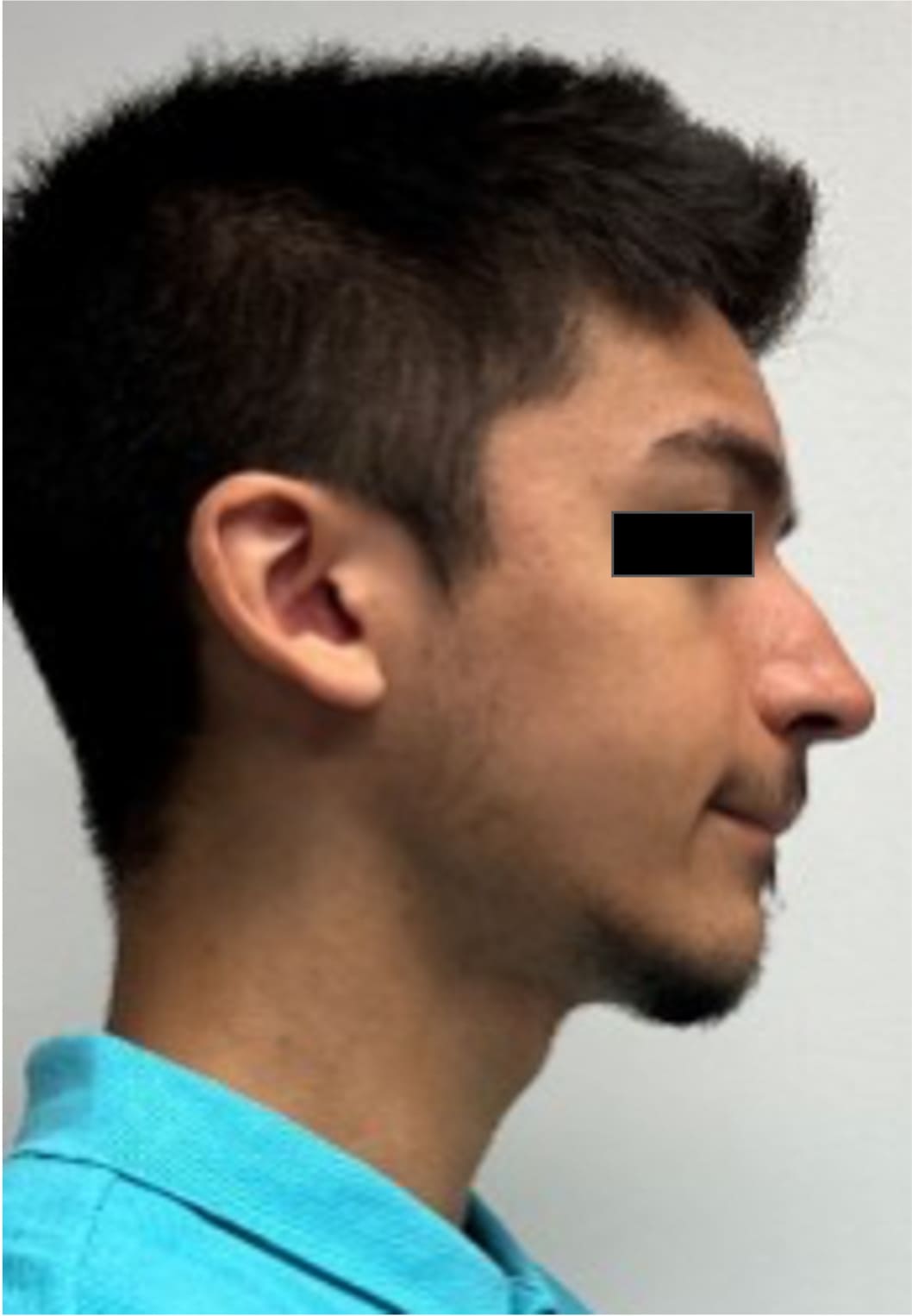 Before rhinoseptoplasty showing the nose prior to surgery, right side view