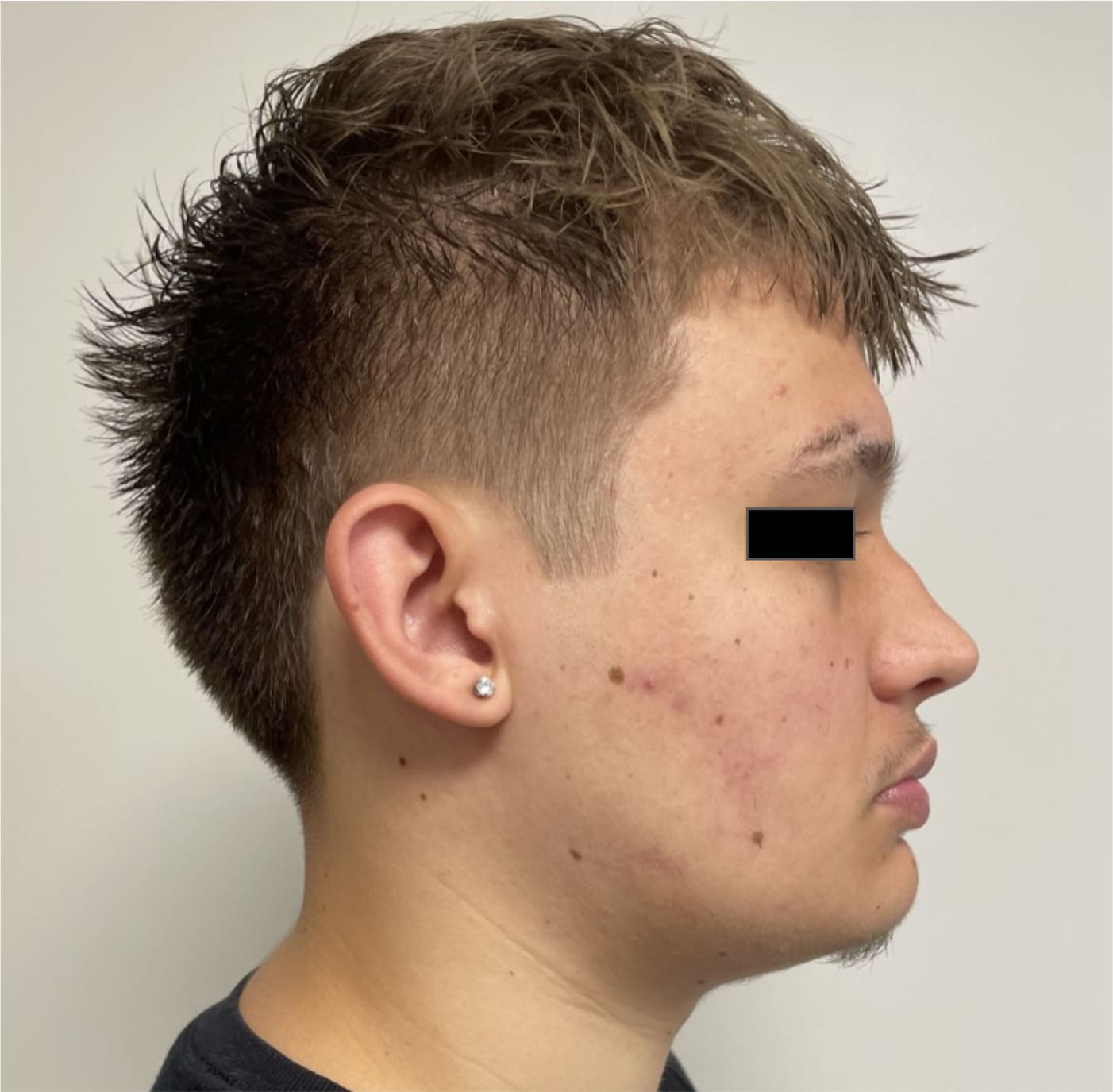 Before rhinoseptoplasty showing the nose prior to surgery, right side view