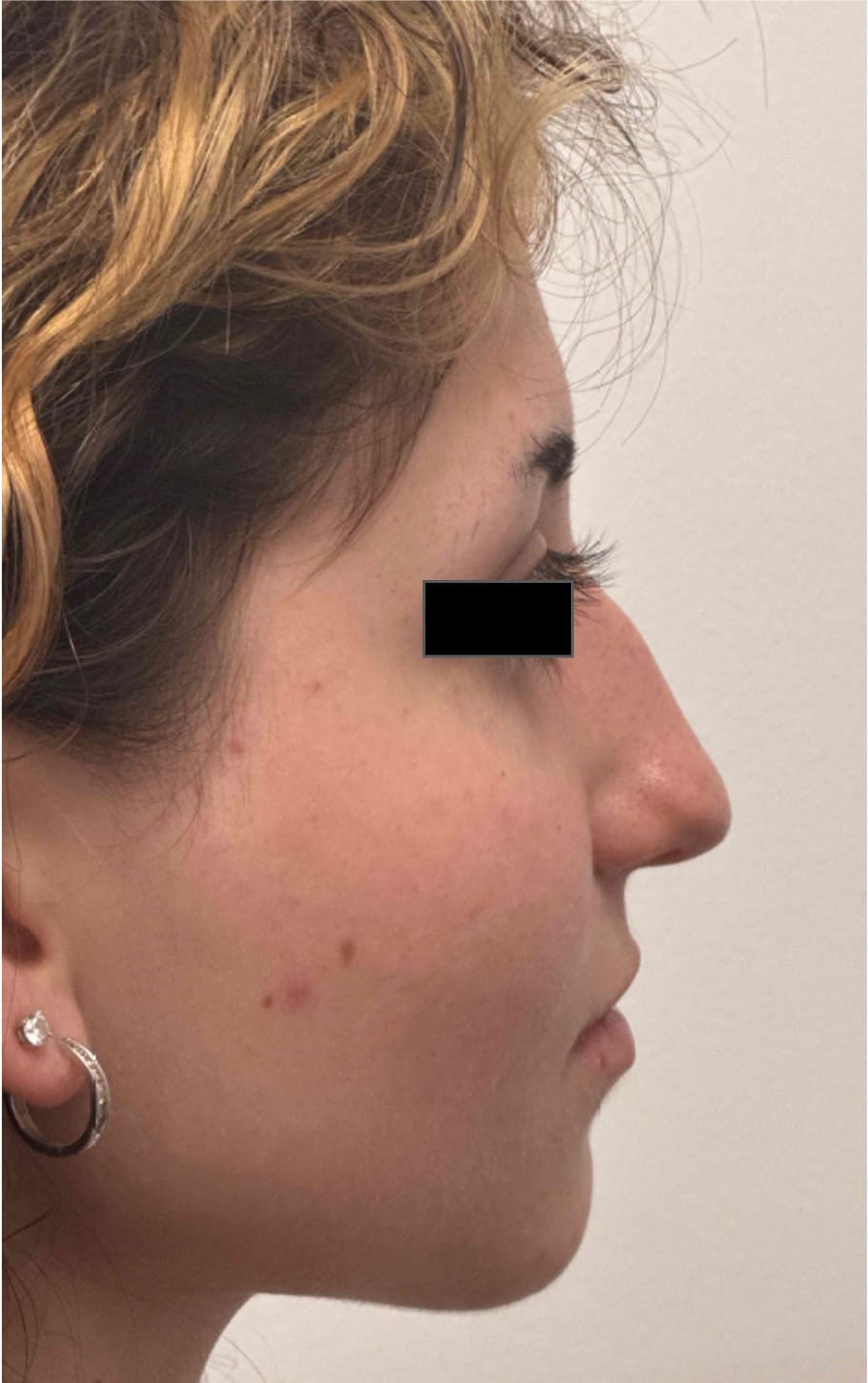 Before rhinoseptoplasty showing the nose prior to surgery, right side view