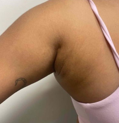Before right axillary breast tissue removal showing excess tissue in the underarm area